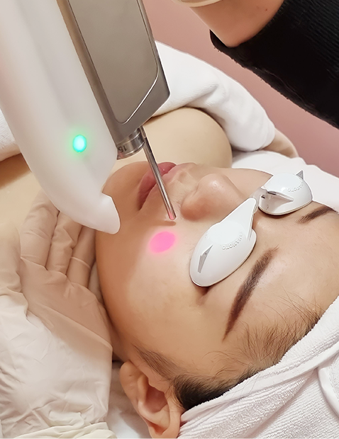 Close up picture of a woman undergoing laser treatment for acne scars.