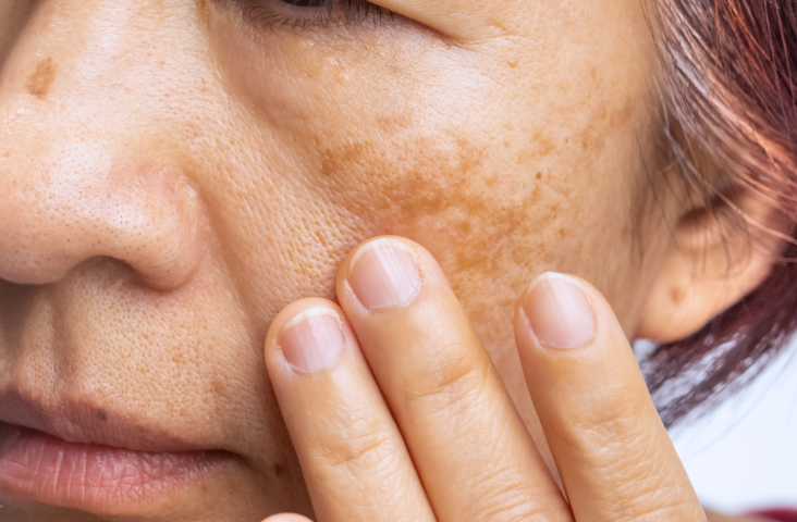 Woman with hyperpigmentation.