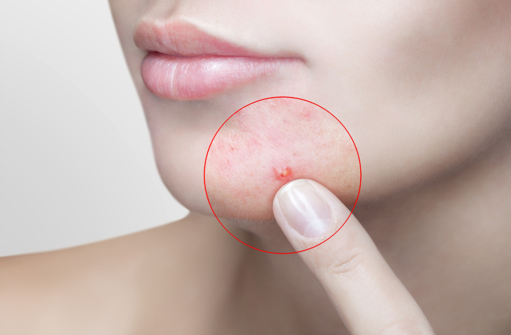 Small, red bump showing the effects of an acne scar.