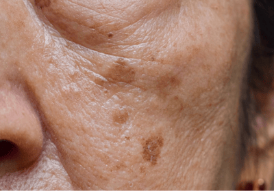 an image of a type of pigmentation - age spots; on the cheek