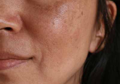 an image of a type of pigmentation - chloasma; on the face