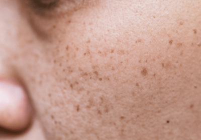 an image of a type of pigmentation - freckles; on the cheek