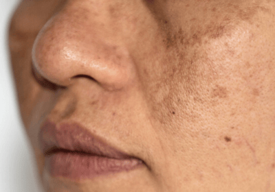 an image of a type of pigmentation - hyperpigmentation; on the face
