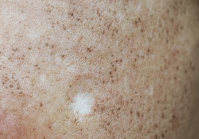 an image of a type of pigmentation - hypopigmentation; on the skin