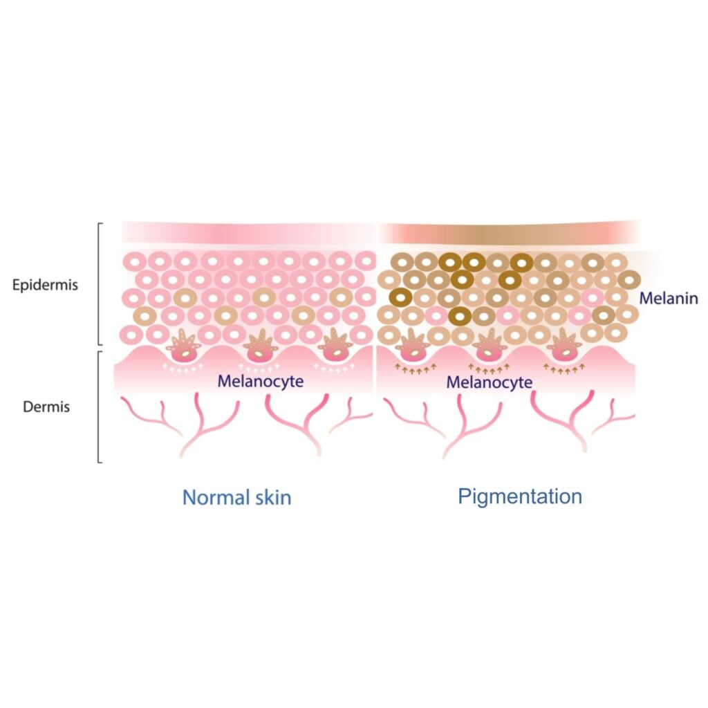 a diagram of a comparison of a cross-section of skins between normal and pigmentation skins.