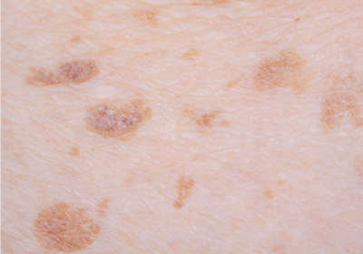an image of a type of pigmentation - lentigines; on the skin