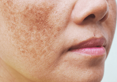 an image of a type of pigmentation - melasma; on the cheek