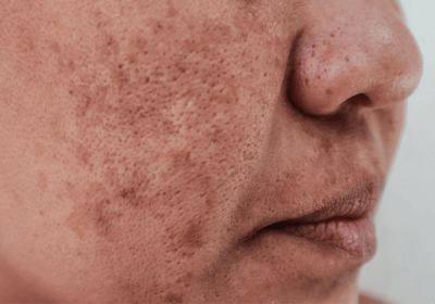 an image of a type of pigmentation - post-inflammatory hyperpigmentation; on the cheek